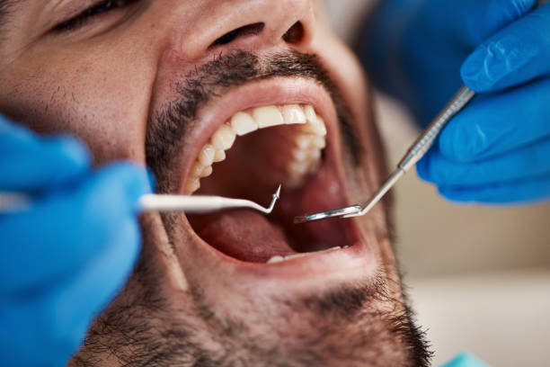 Best Emergency Wisdom Teeth Removal in Village Green Green Ridge, PA